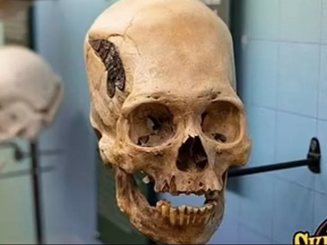 Более 2000 лет: археологи обнаружили череп со следами хирургической операции